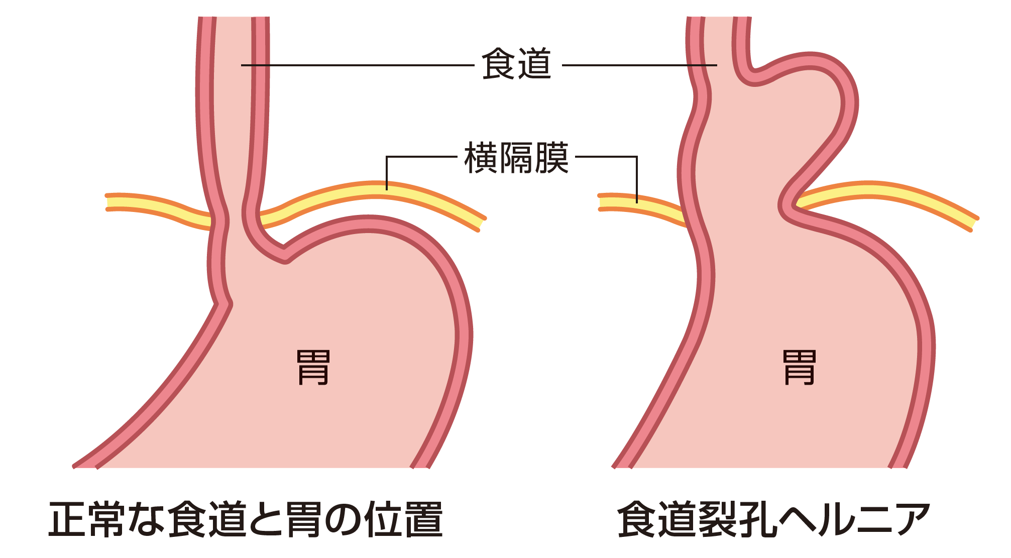 に 食後 なる 横