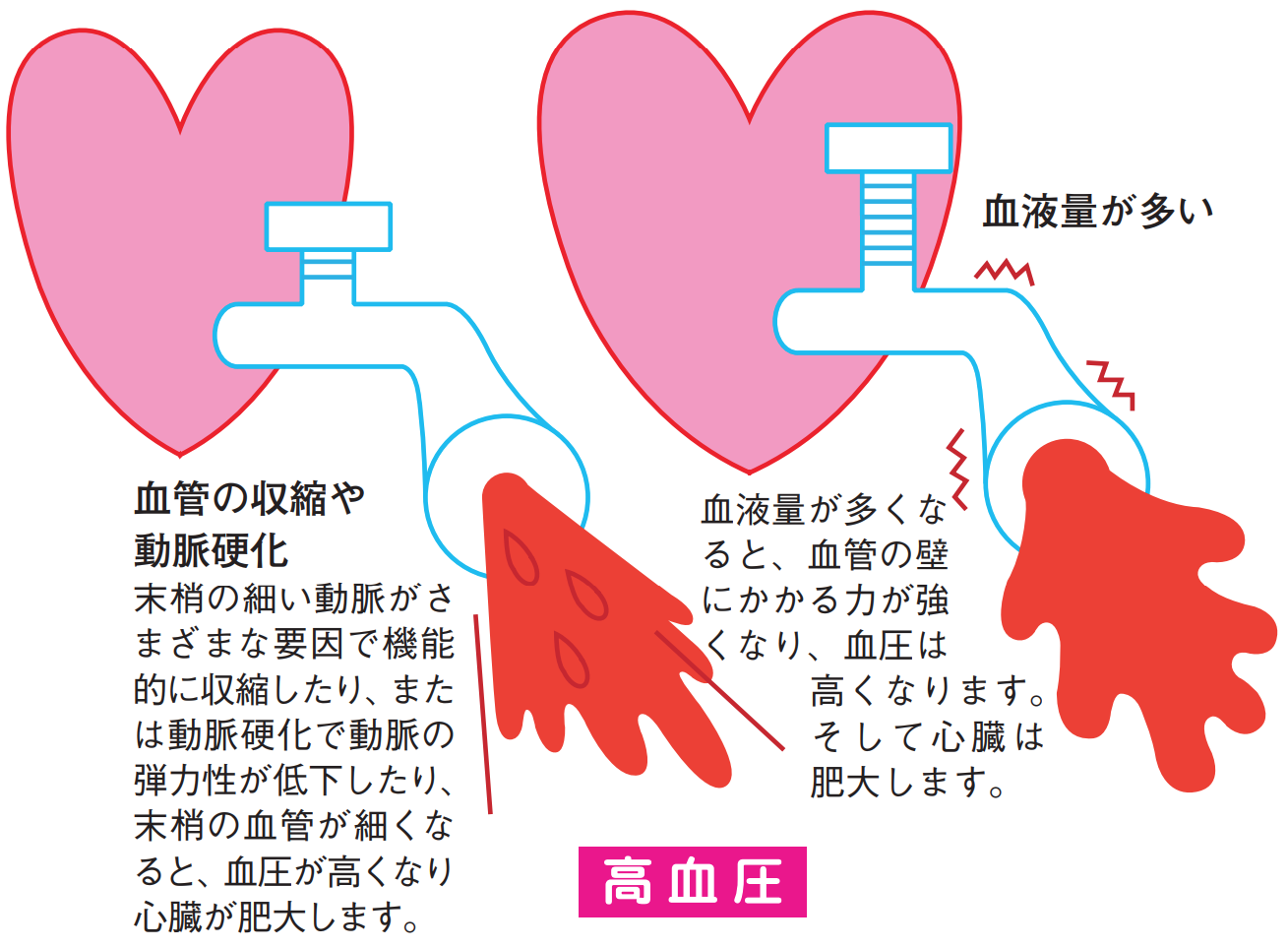 高血圧　血管の収縮や動脈硬化