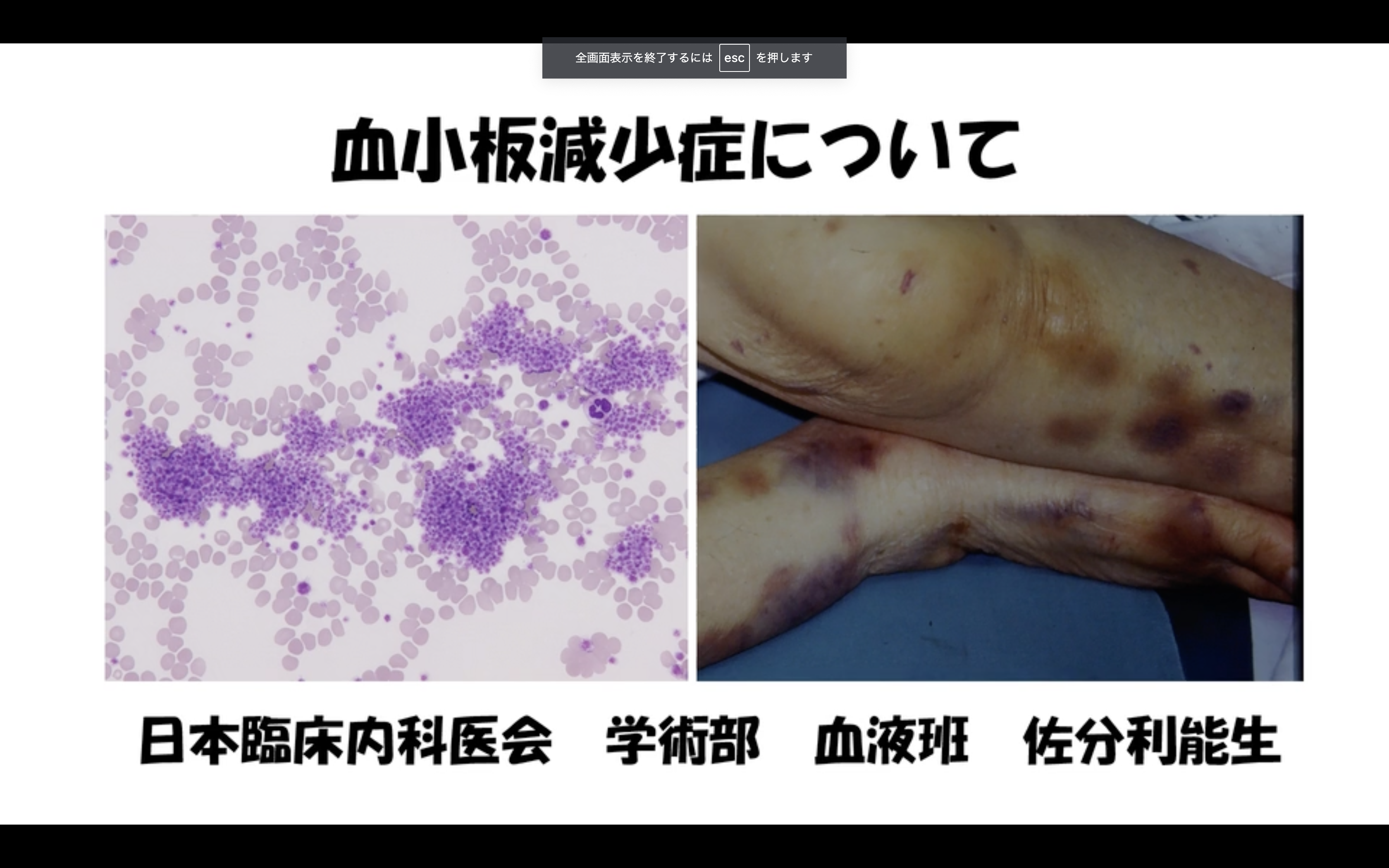 血小板減少について